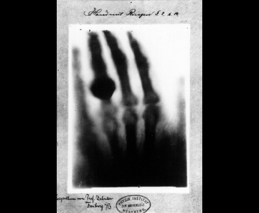 X-ray image in black, white, and gray of a female hand wearing a ring.
